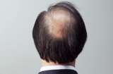 男人治疗脱发看3点  这些营养素不让你掉一根头发
