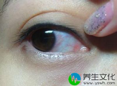 角膜炎是一种严重的眼科疾病