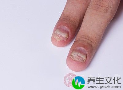 灰指甲是导致一些恶性肿瘤产生的原因