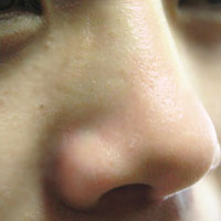 治过敏性鼻炎偏方 怎样治疗过敏性鼻炎