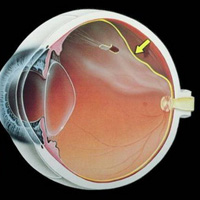 治疗中心性视网膜脉络膜炎的中药方剂