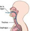 食管裂孔疝（外科）