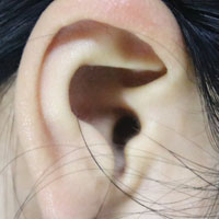 中耳炎的治疗偏方 中耳炎怎样用饮食治疗
