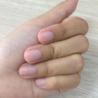灰指甲偏方 6种偏方助你治疗灰指甲