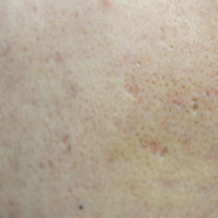 治疗皮肤过敏的偏方 中医怎样治疗皮肤过敏