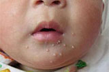 儿童传染性软疣有什么特点？传染性软疣的治疗方法