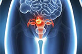 导致子宫内膜癌的原因是什么？有哪些治疗方法？