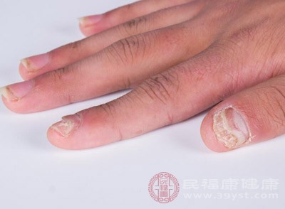 灰指甲的治疗方法 灰指甲怎么治疗