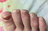 灰指甲的临床表现有哪些 日常需要怎样护理