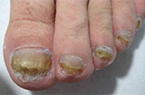 灰指甲的危害你不得不知 灰指甲日常护理方法