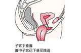 子宫脱垂产生的原因是什么 该如何治疗子宫脱垂