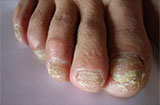 灰指甲比脚气难治愈的原因 易感染灰指甲人群有哪些