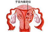 什么是子宫内膜异位症？如何诊断子宫内膜异位症？