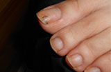灰指甲的晚期有哪些常见症状 灰指甲怎么护理好