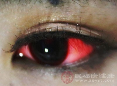 红眼病的症状 这样做有效治疗红眼病