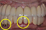 牙龈炎的常见症状有哪些 日常预防牙龈炎应该怎么做