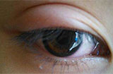 角膜炎和结膜炎有什么区别？是否都会影响视力呢？