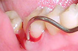 牙龈炎的临床表现有哪些 得了牙龈炎要注意什么