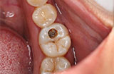 你知道什么是龋齿吗？哪些人更容易患龋齿呢