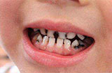 儿童有了龋齿怎么办？平时应该注意些什么