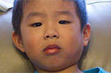 儿童腮腺炎早期有哪些症状 腮腺炎的潜伏期是多久