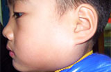 如何知道宝宝得了腮腺炎？流行性腮腺炎该怎么治疗