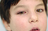 导致小儿结膜炎的原因有哪些 结膜炎该如何治疗呢