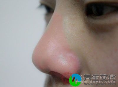 鼻炎可以引起鼻子的不通畅