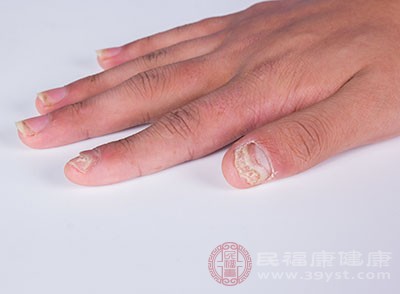 引起灰指甲的原因 灰指甲可以这样治疗