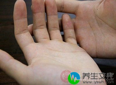 鳞屑水疱型是手足藓常见的一种症状