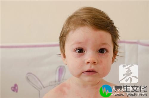 小孩荨麻疹是怎么引起的？