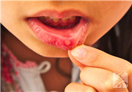 口腔溃疡频繁发作的原因