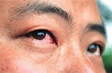 红眼病早期有哪些常见症状
