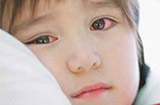 红眼病的表现 日常需要怎样护理