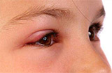 如何调理红眼病 红眼病应该怎么改善