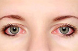 红眼病平时应该注意些什么 红眼病的注意事项