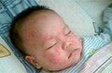 引起急性荨麻疹的原因？急性荨麻疹应该如何治疗