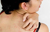 寒冷性荨麻疹的病因有哪些？怎么预防荨麻疹