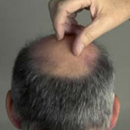 男性秃顶的6大健康危机 秃顶怎么办?