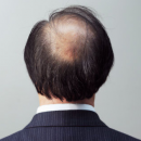 男性秃顶隐藏六信号 心脏病风险高免疫系统障碍